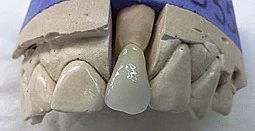 Зубна металокераміка