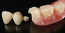 Clasp Dental Prothesis